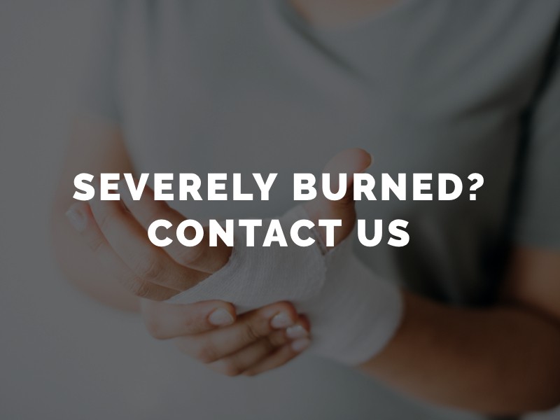 Los Angeles Burn Injury Attorney